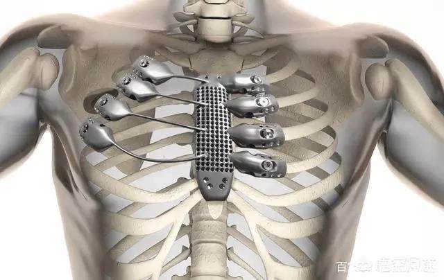 What happens if you replace all the bones in your body with titanium?